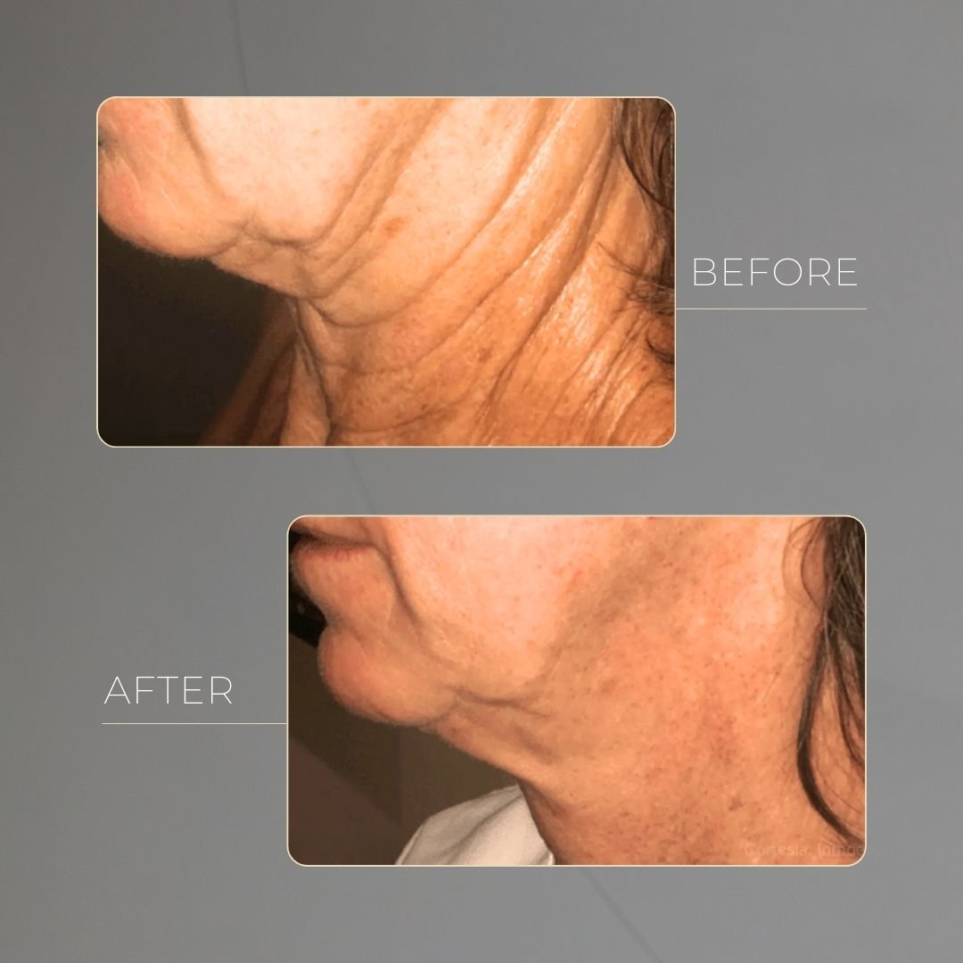 Morpheus8 before and after in Medellín at Clínica Be Dharma — case 3