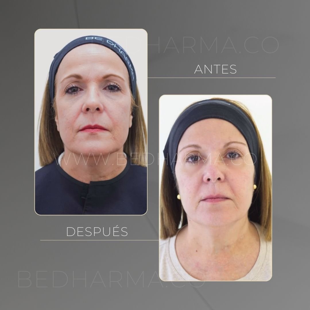 Sculptra facial firmness before and after in Medellín
