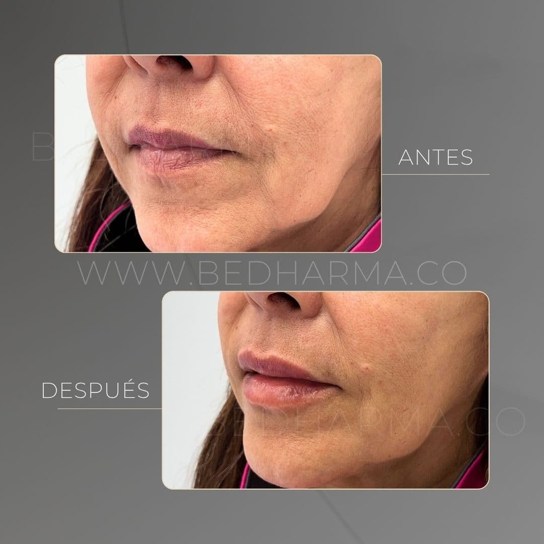 Aumento de labios con ácido hialurónico antes y después en la clínica estética Be Dharma - 011025
