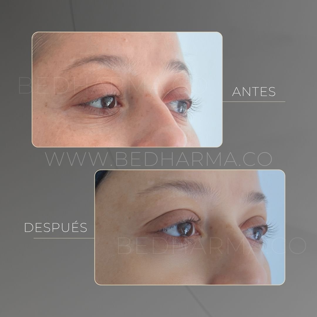 Under-eye circles before and after in Medellín at Be Dharma aesthetic clinic (011025)