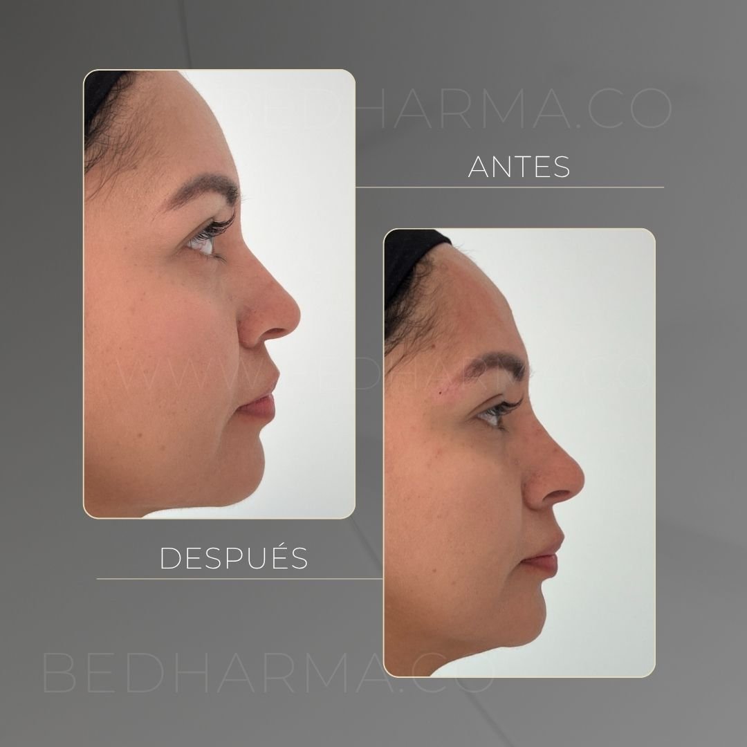Nose reshaping before and after at the Be Dharma aesthetic clinic in Medellín