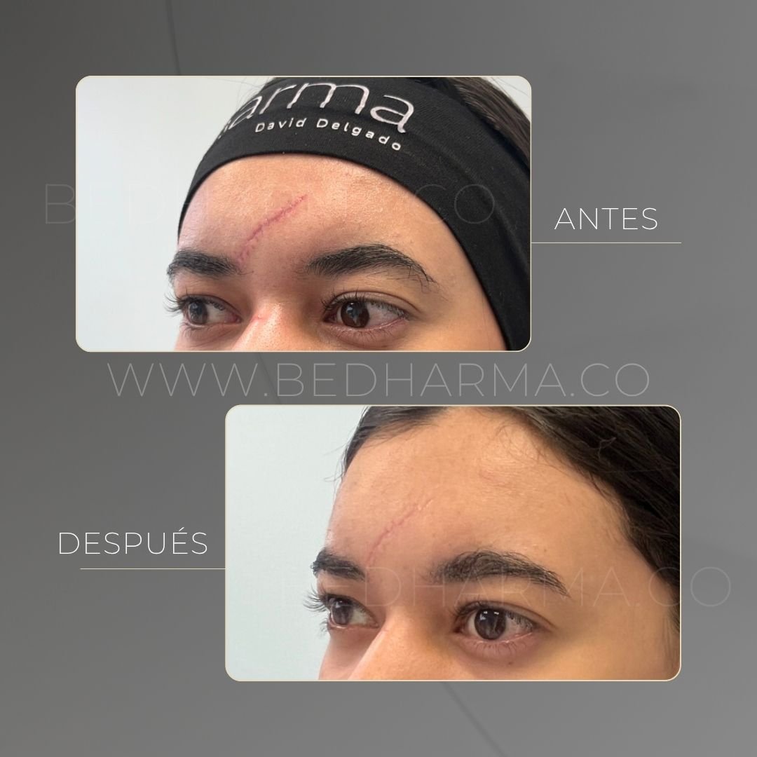 Scar treatment before and after at the Be Dharma aesthetic clinic in Medellín