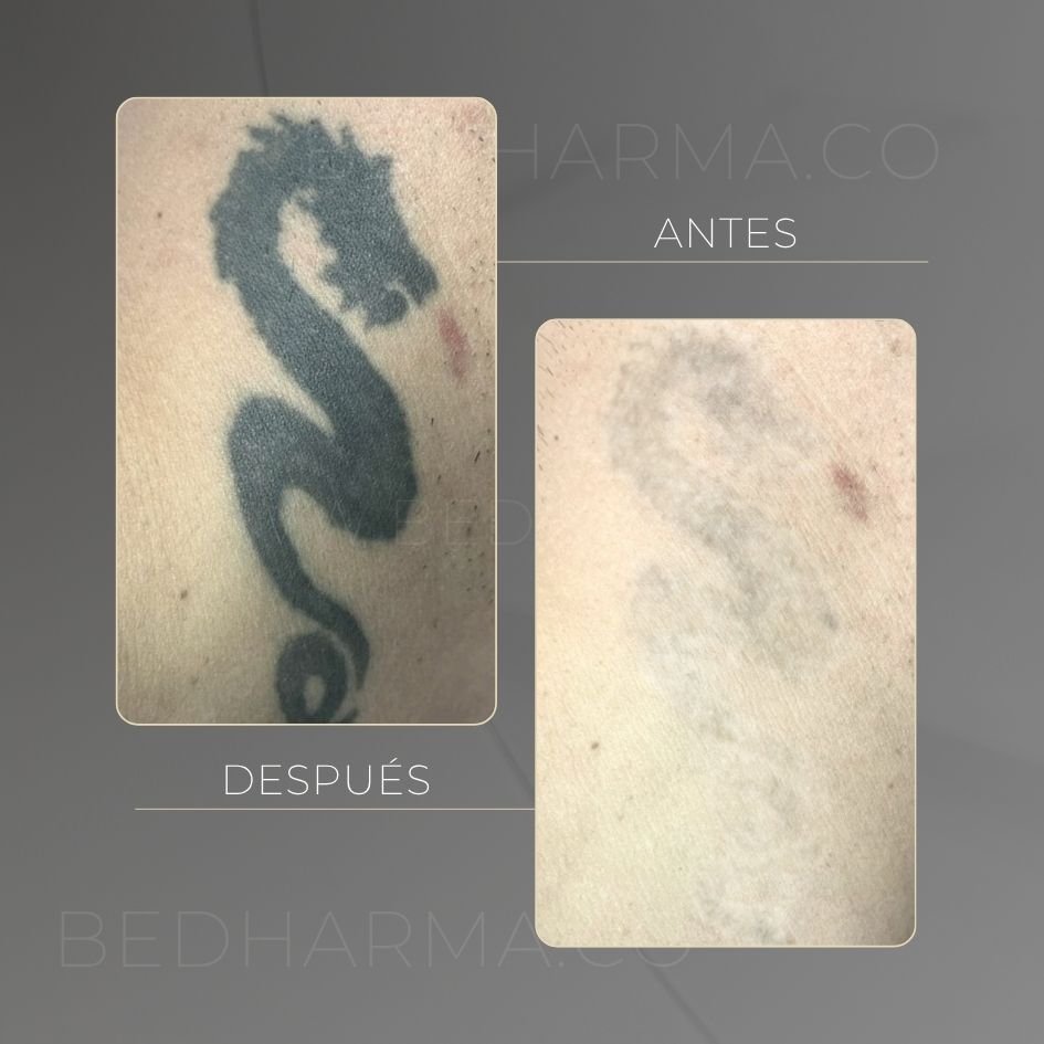 Tattoo removal with ColorMAX in Medellín at Clínica Be Dharma