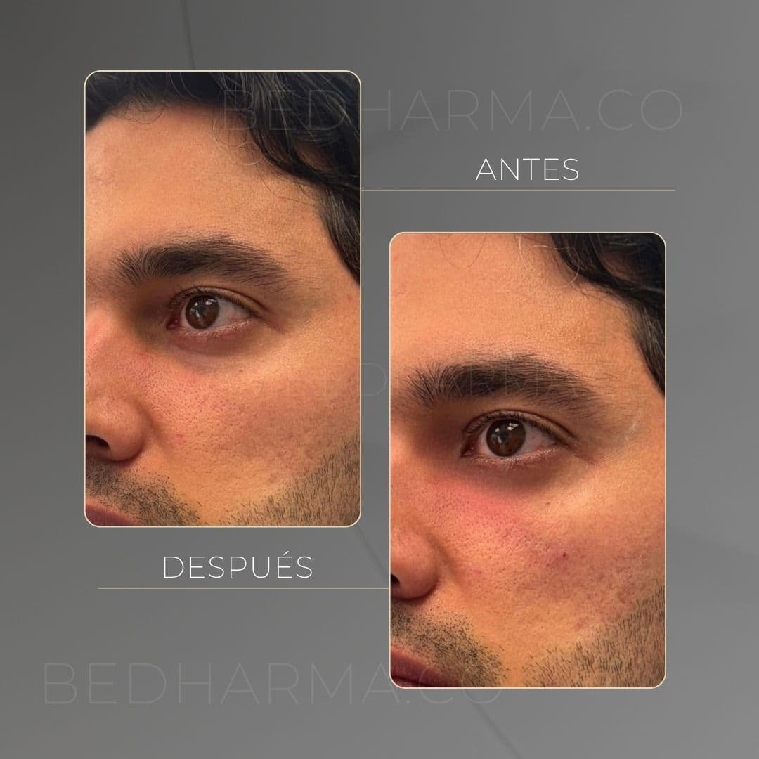 Under-eye circles before and after in Medellín at Be Dharma aesthetic clinic (041125)
