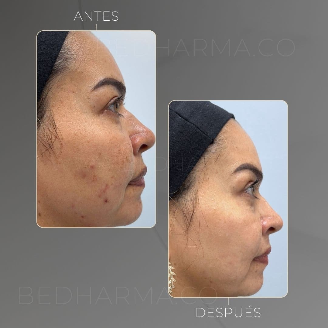 ColorMAX laser for dark spots before and after at Clínica Be Dharma, Medellín