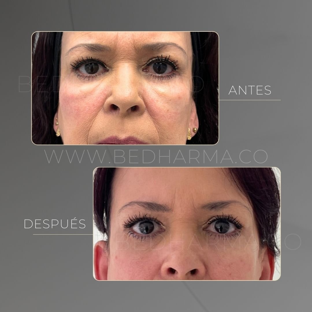Under-eye treatment with Ultraformer MPT before and after in Medellín