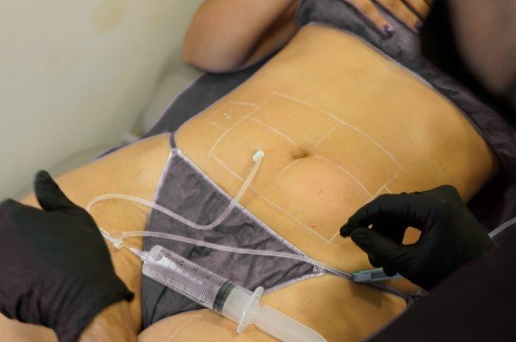 Tratamientos para eliminar grasa sin cirugía en 2026 - Clínica be Dharma de Medellín - Hidrolipoclasia