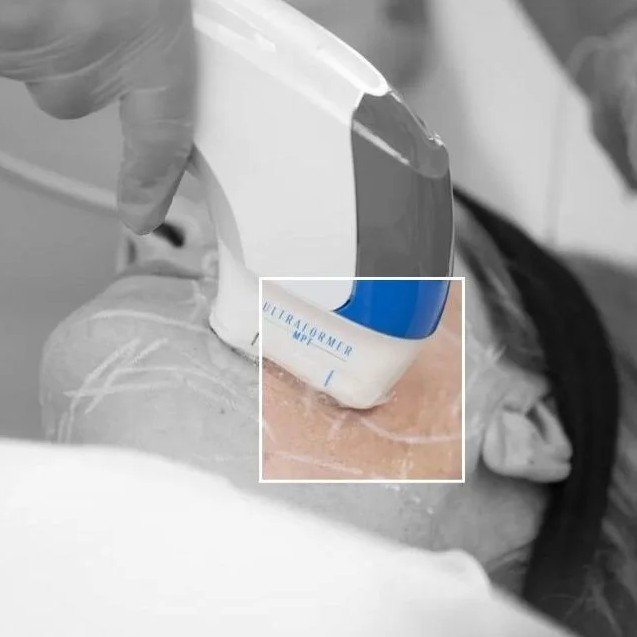 Ultraformer Hifu in Medellín - Be Dharma Aesthetic clinic