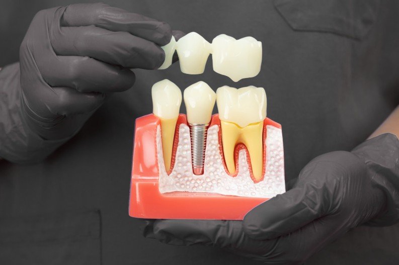 Coronas dentales en Medellín - Centro de odontología estética Be Dharma Dental - Clínica Be Dharma