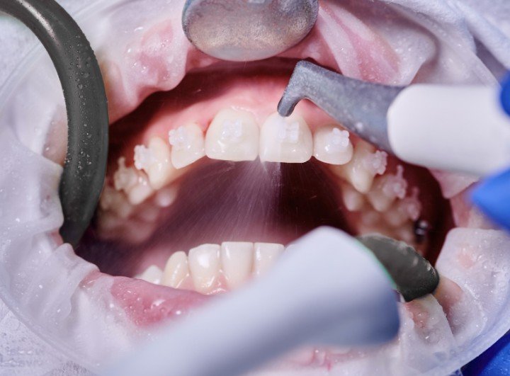 Detartraje en Medellín - Centro de odontología estética Be Dharma Dental - Clínica Be Dharma