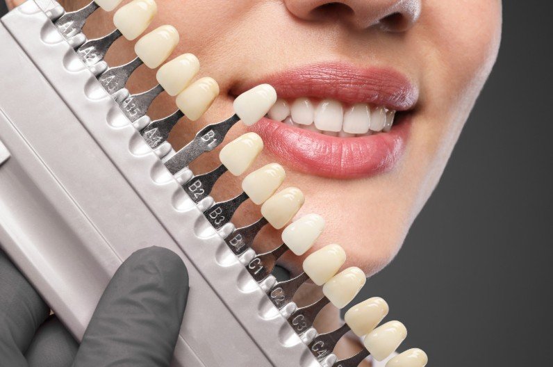 Diseño de sonrisa en Medellín - Centro de odontología estética Be Dharma Dental - Clínica Be Dharma