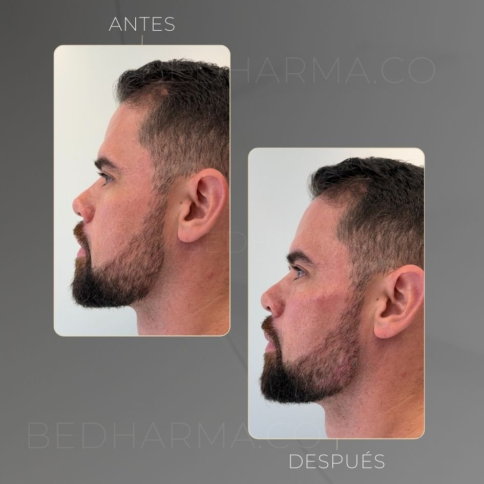 Masculinización facial con ácido hialurónico en Clínica Be Dharma - caso de antes y después