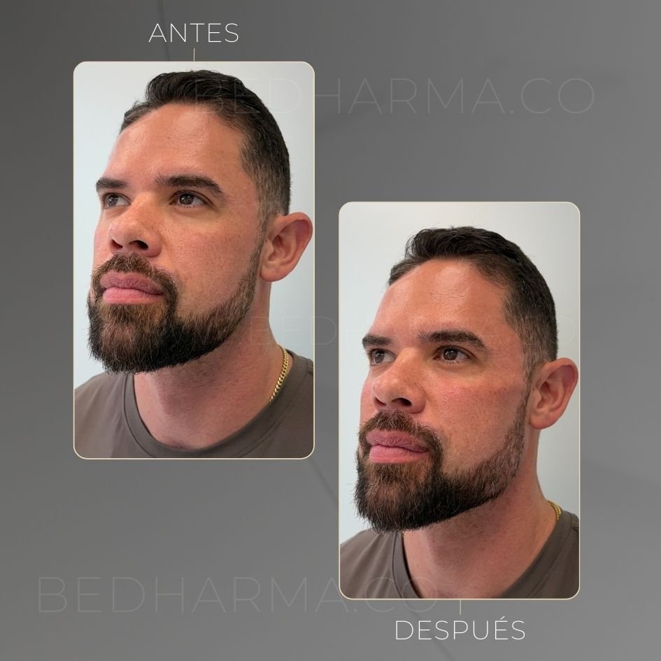 Masculinización facial con ácido hialurónico y radiesse - caso de éxito