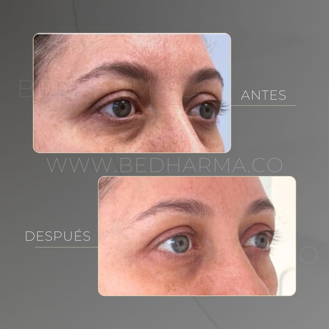 Reducción de ojeras con ácido hialurónico XelaRederm - Clínica Estética Be Dharma