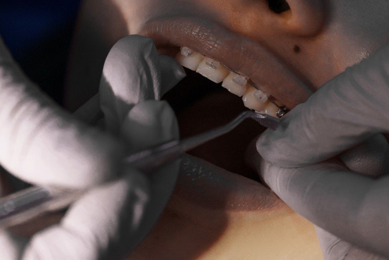Retiro de brackets en Medellín - Centro de odontología estética Be Dharma Dental - Clínica Be Dharma