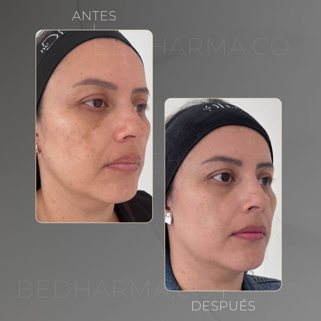 ColorMAX laser result for skin spots at Clínica Be Dharma in Medellín