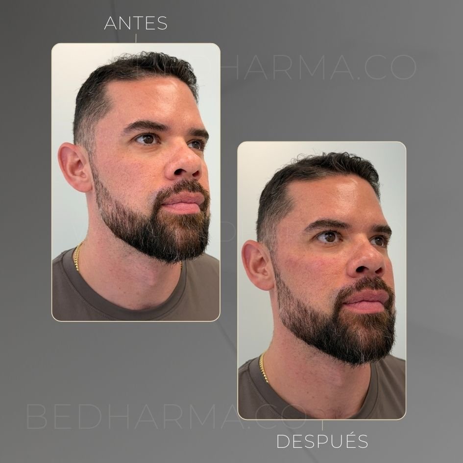 Facial masculinization in Medellín at Clínica Be Dharma