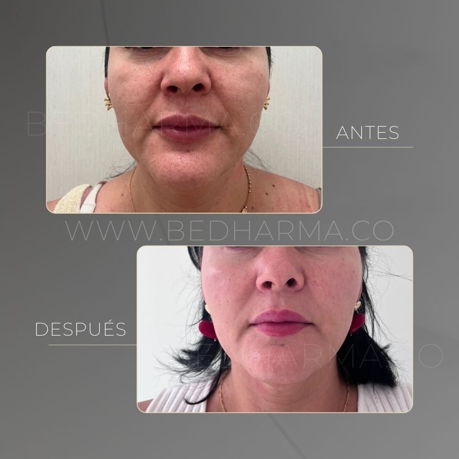 Non-surgical facelift with Ultraformer MPT before and after in Medellín