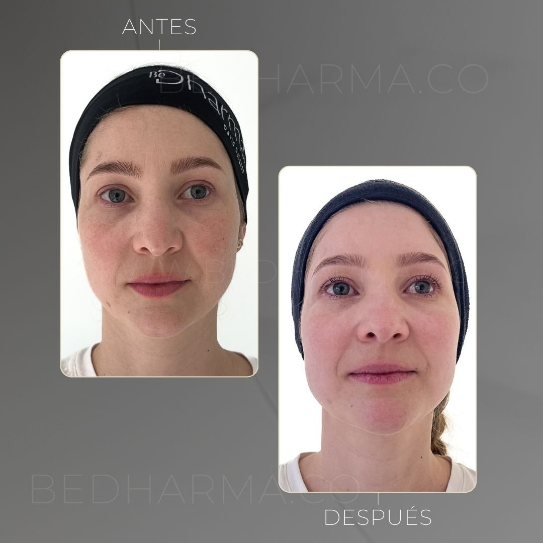 Removing skin spots with ColorMAX laser at Clínica Be Dharma in Medellín