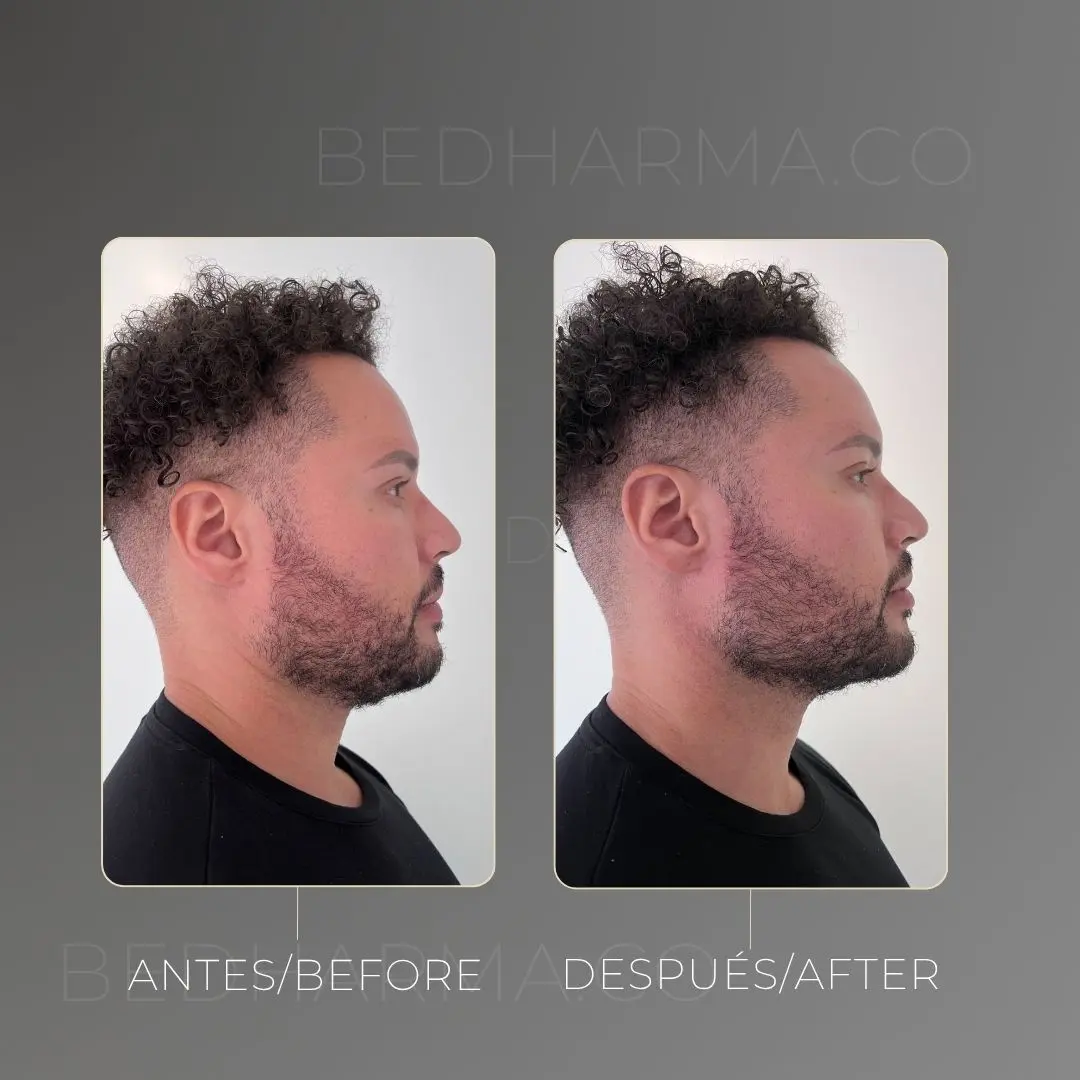 Facial masculinization before and after at Be Dharma aesthetic clinic in Medellín
