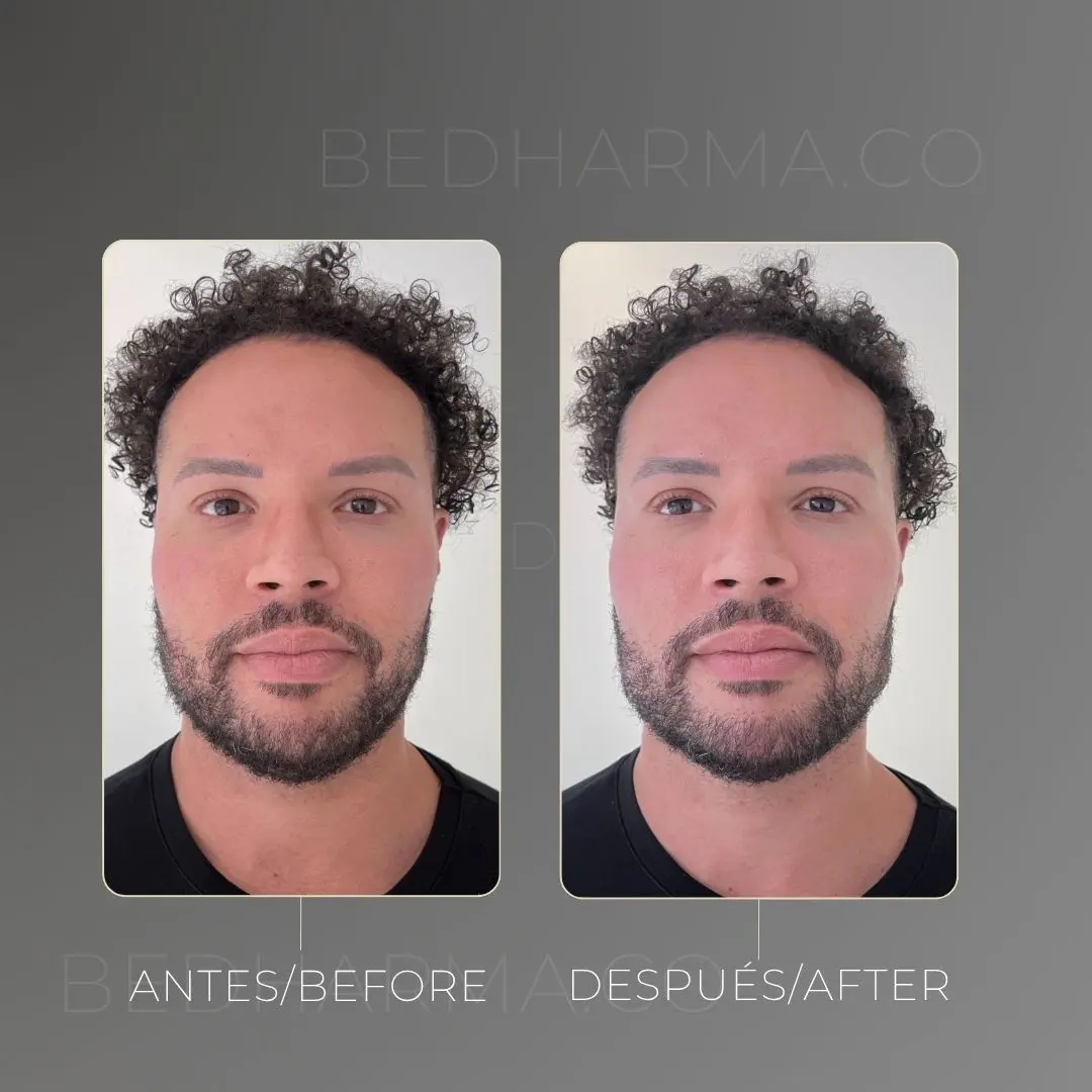 Facial masculinization before and after in Medellín at Be Dharma aesthetic clinic