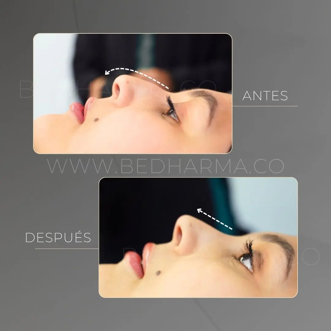 Non-surgical nose reshaping before and after at Clínica Be Dharma in Medellín