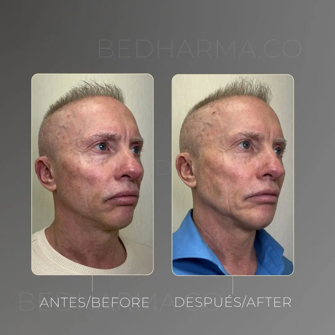 Full face con bioestimuladores antes y después - Clínica estética Be Dharma de Medellín - 080425 1