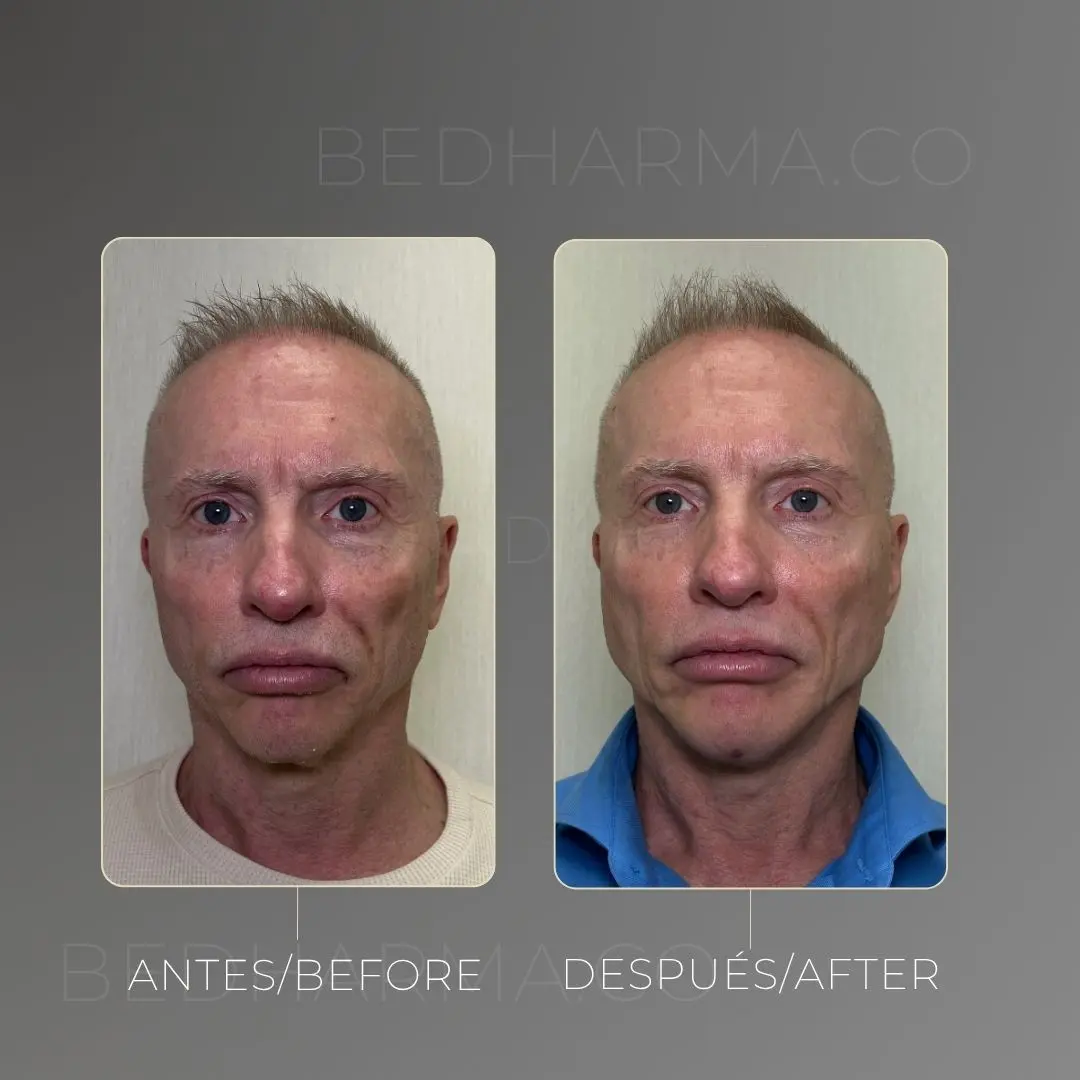 Full face con bioestimuladores antes y después - Clínica estética Be Dharma de Medellín - 080425