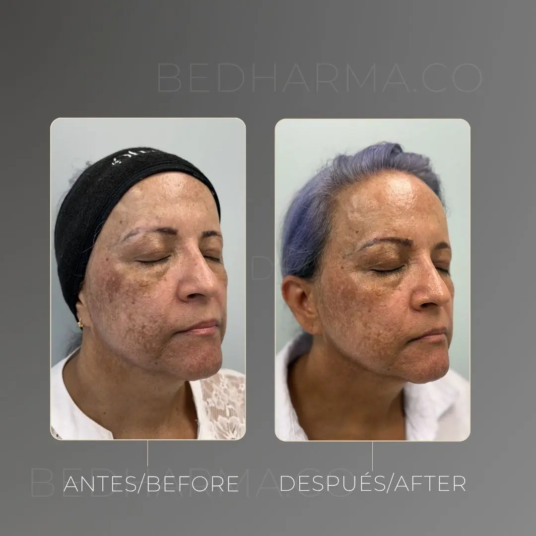 Tratamiento para el melasma antes y después - Clínica estética Be Dharma de Medellín - 300425 1