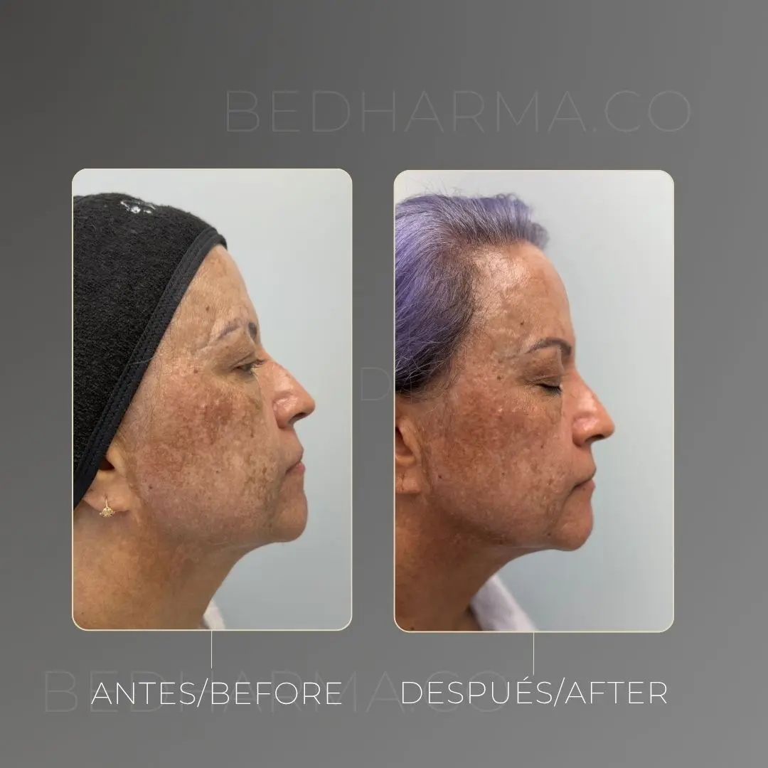 Tratamiento para el melasma antes y después - Clínica estética Be Dharma de Medellín - 300425 2