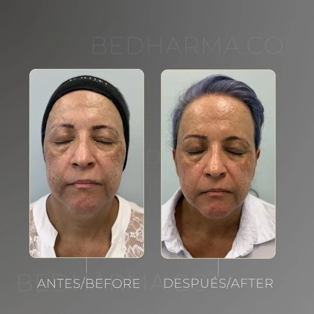 Tratamiento para el melasma antes y después - Clínica estética Be Dharma de Medellín - 300425