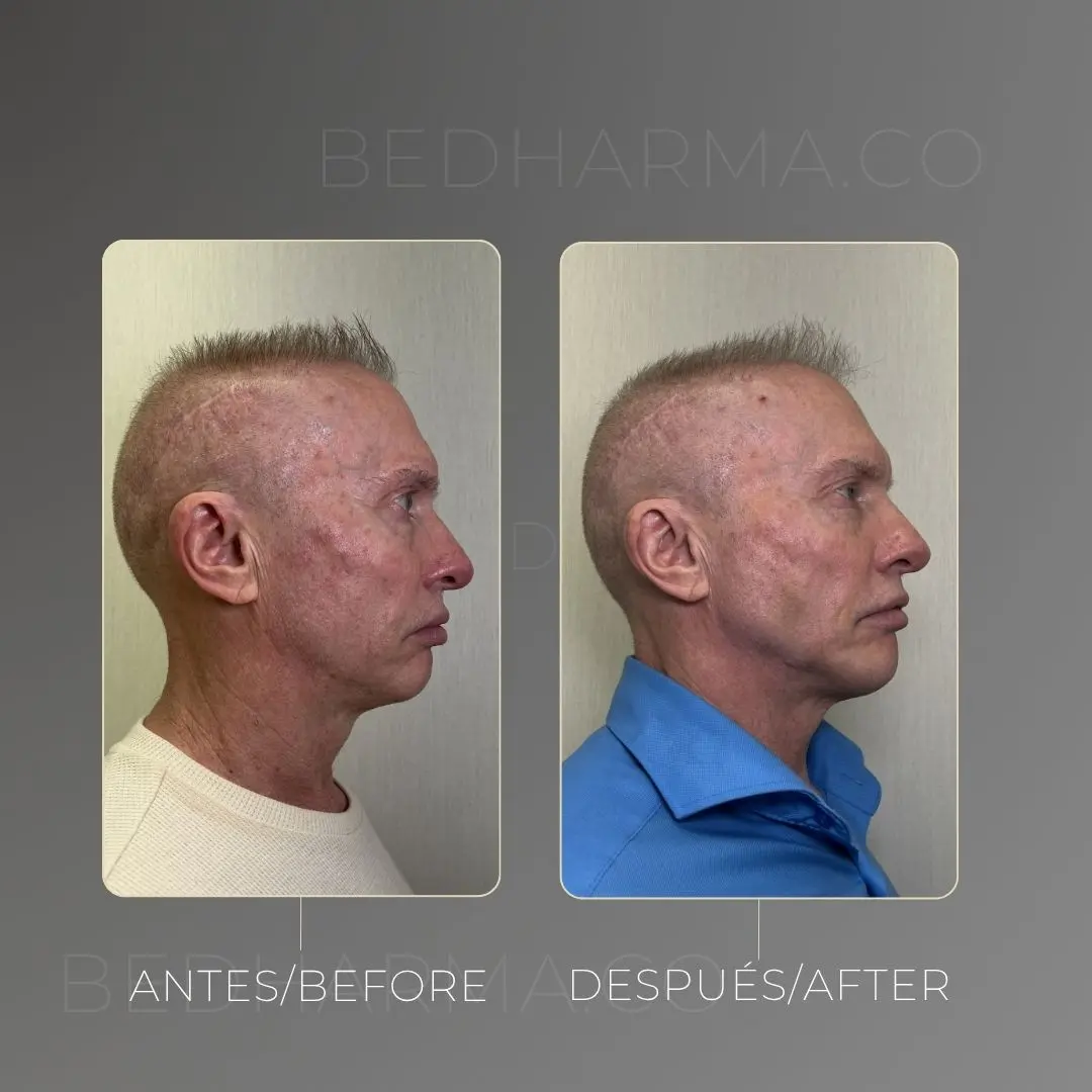 Collagen biostimulators before and after in Medellín at Be Dharma aesthetic clinic