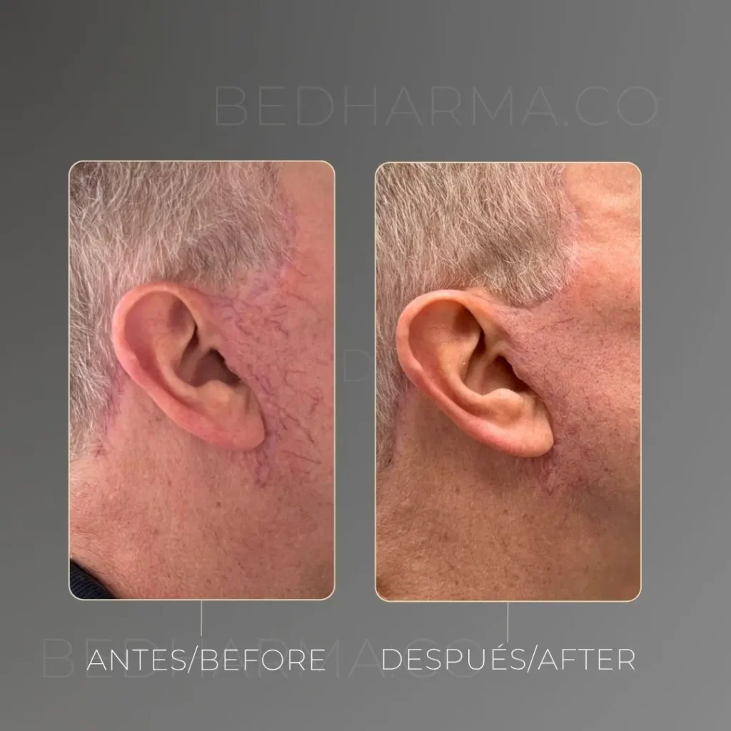 Sclerotherapy before and after in Medellín at Be Dharma aesthetic clinic (220425)