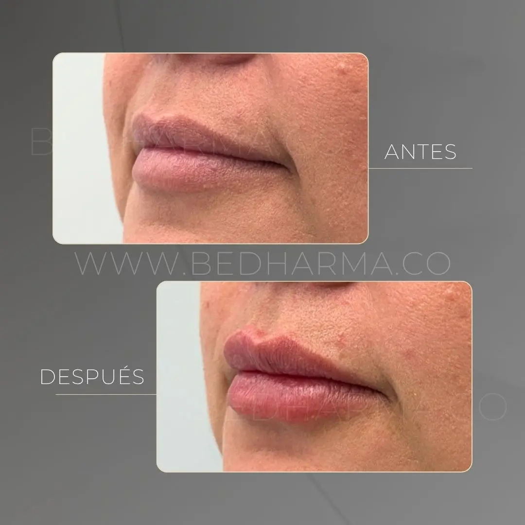 Aumento de labios con ácido hialurónico antes y después en la clínica estética Be Dharma - 090626 2