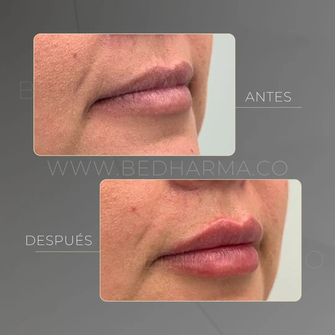 Aumento de labios con ácido hialurónico antes y después en la clínica estética Be Dharma - 090626 3