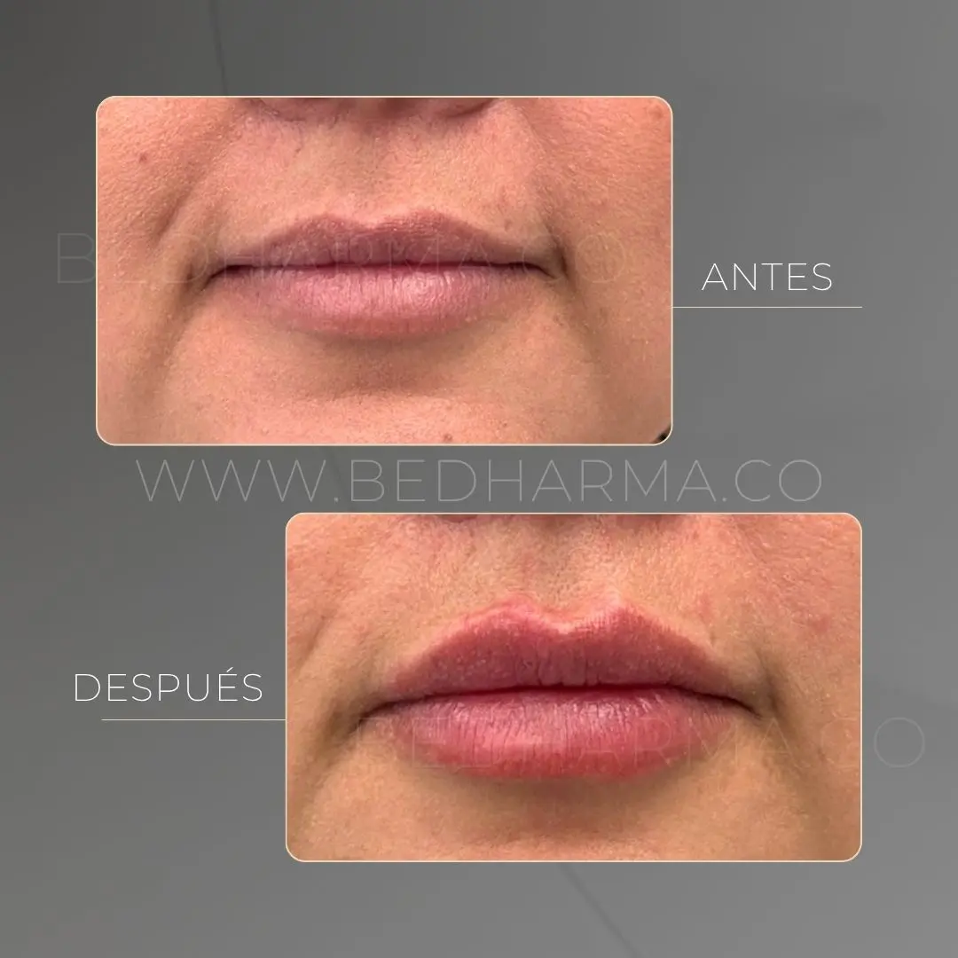 Aumento de labios con ácido hialurónico antes y después en la clínica estética Be Dharma - 090626
