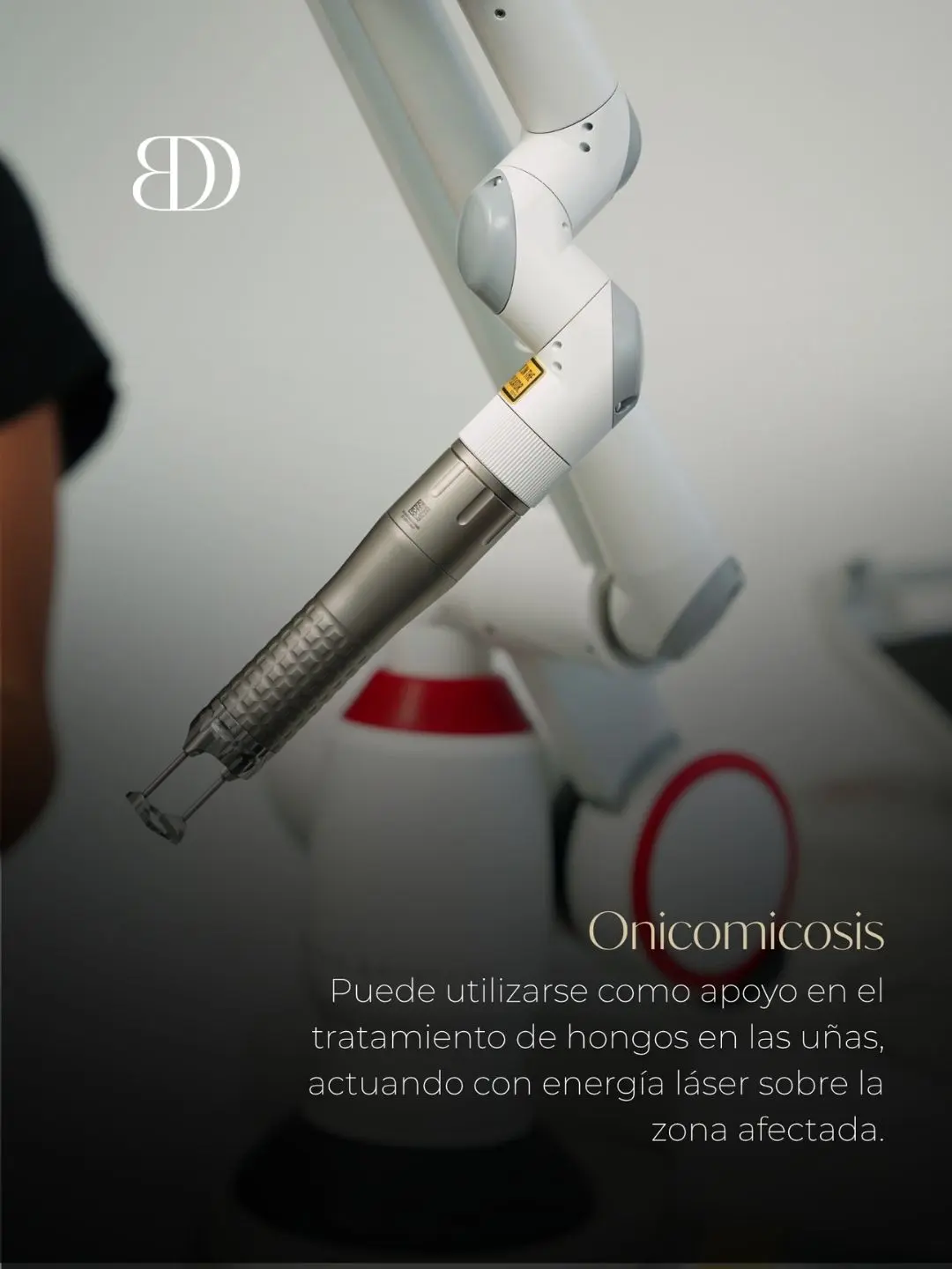 Láser fotona en Medellín - Tratamiento para la onicomicosis - clínica estética Be Dharma