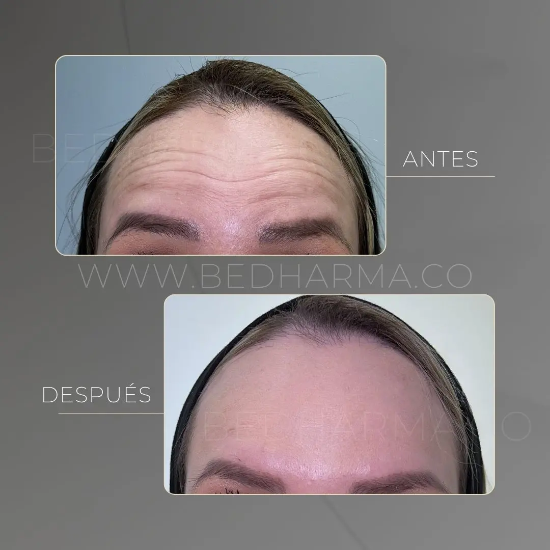 Toxina botulínica en la frente antes y después en la clínica estética Be Dharma - 090626