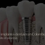 Clínica de implantes dentales en Colombia Conoce todo el proceso - Be Dharma co - MEDELLIN
