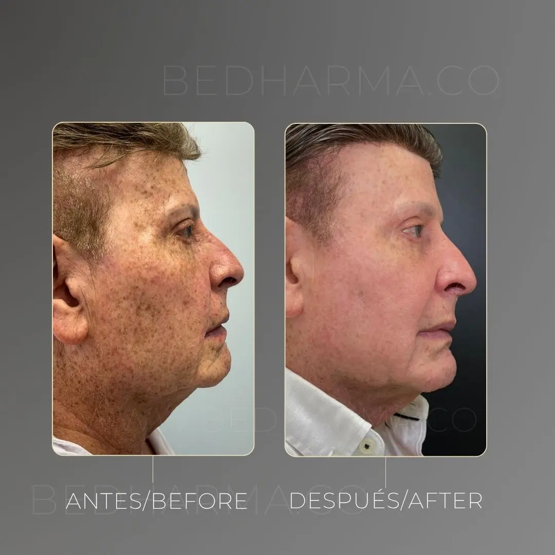 Full face con bioestimuladores antes y después en la clínica estética Be Dharma - 060726 1