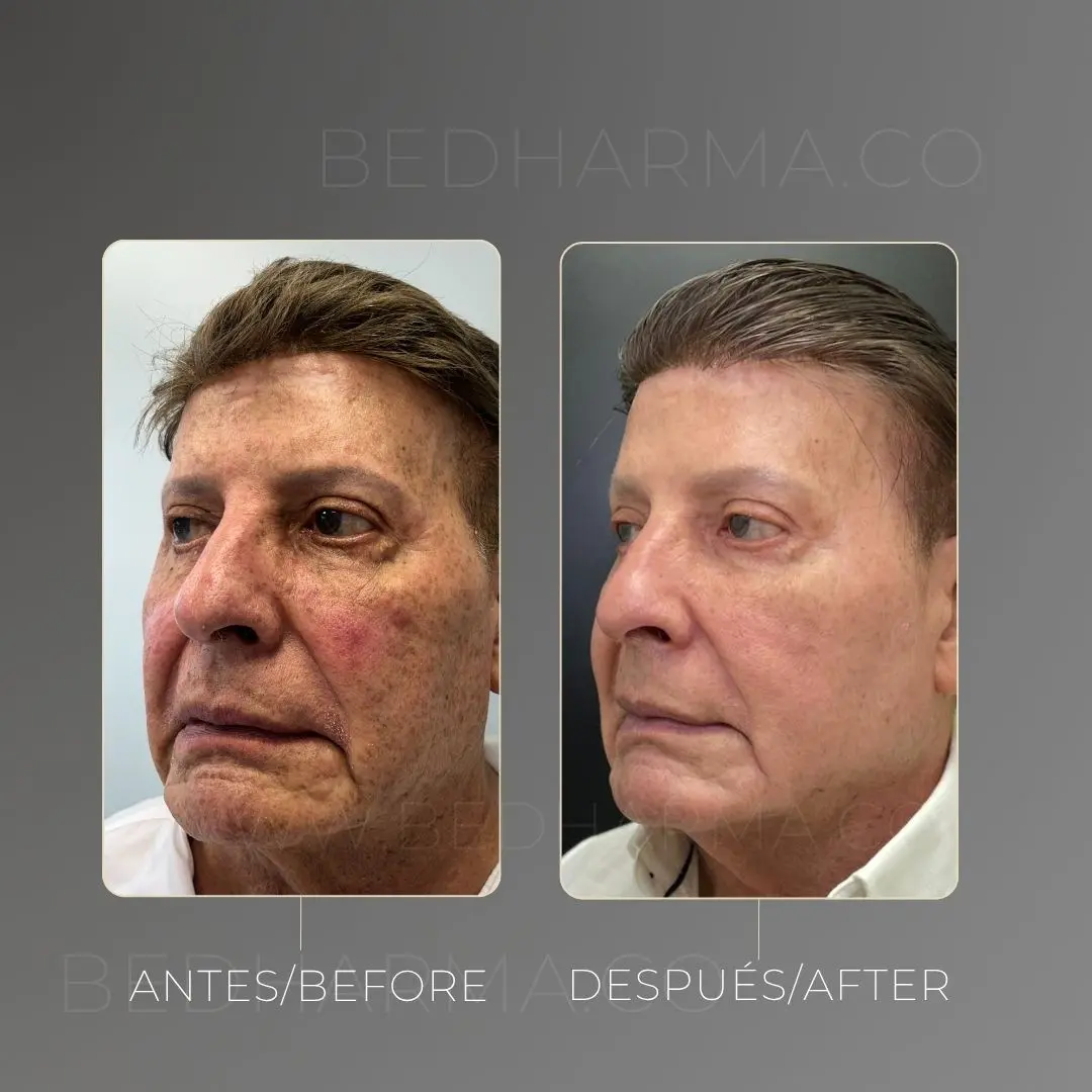 Full face con bioestimuladores antes y después en la clínica estética Be Dharma - 060726 2