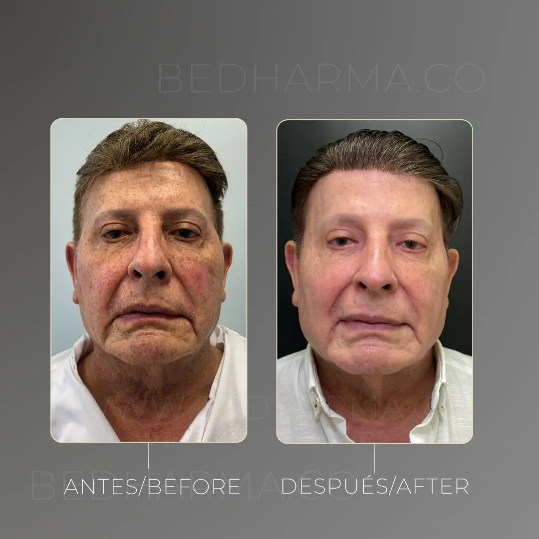 Full face con bioestimuladores antes y después en la clínica estética Be Dharma - 060726