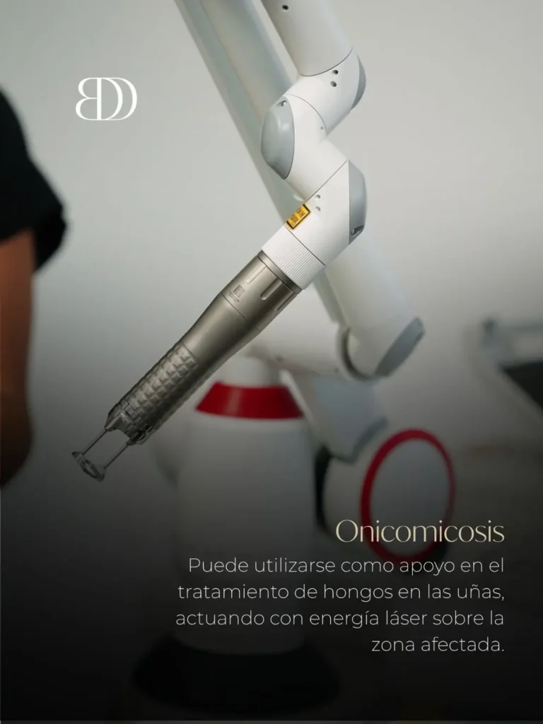 Tratamiento para la onicomicosis con láser Fotona ClearSteps