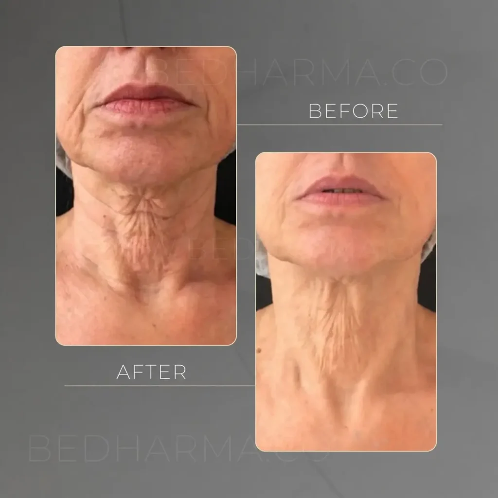 Neck lift non-surgical- Clínica Be Dharma