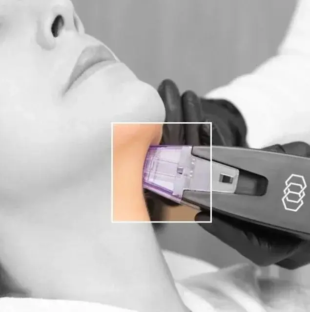 Neck lift non-surgical- Clínica Be Dharma