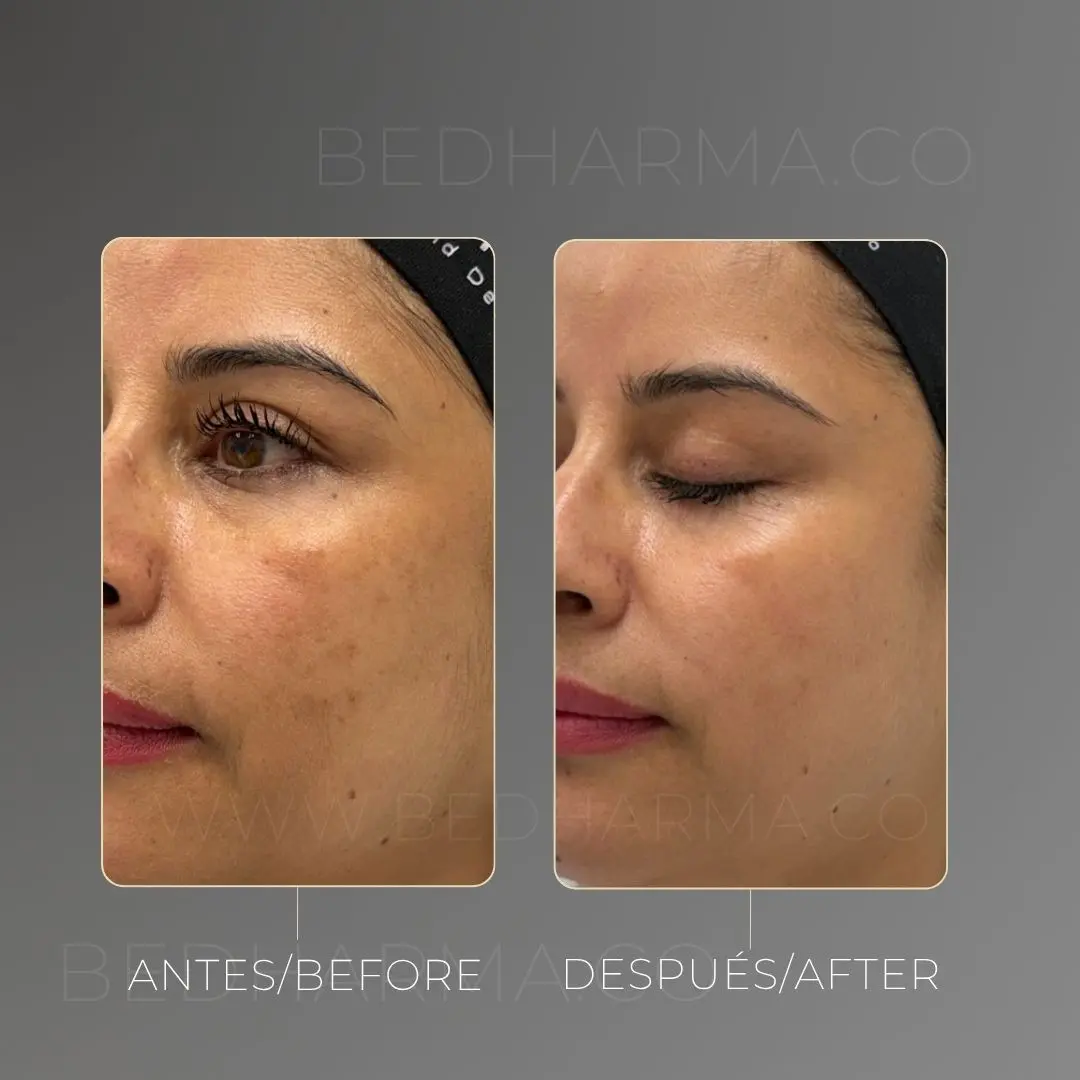 Tratamiento para melasma antes y después en la clínica estética Be Dharma - 060726 1