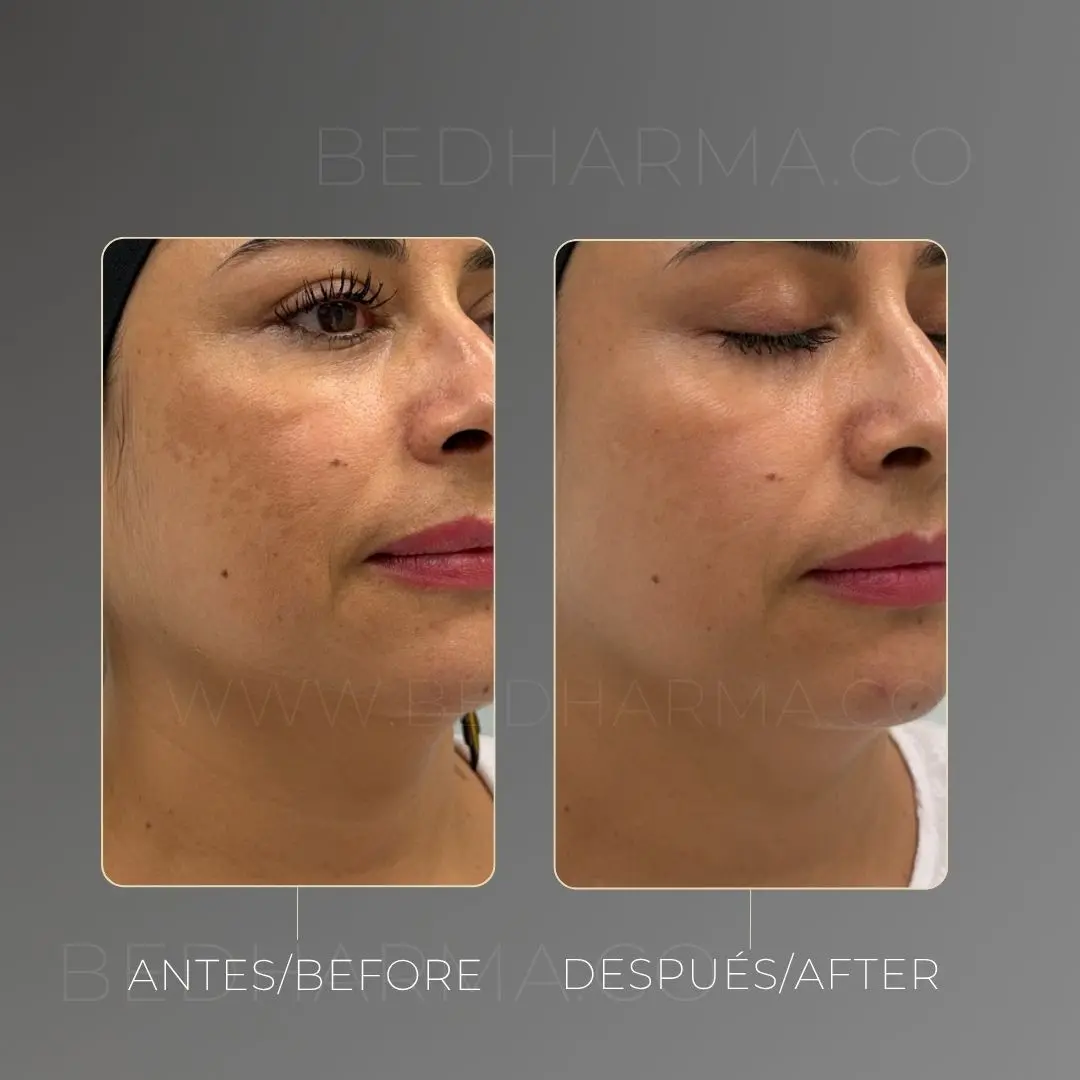 Tratamiento para melasma antes y después en la clínica estética Be Dharma - 060726