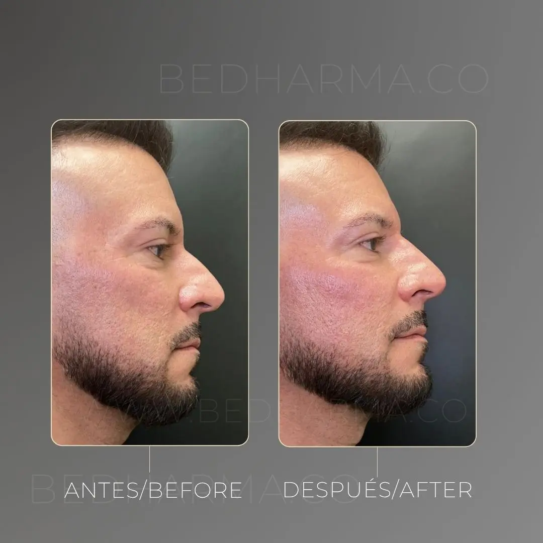 Non-surgical nose job before and after at Be Dharma in Medellín — case 1