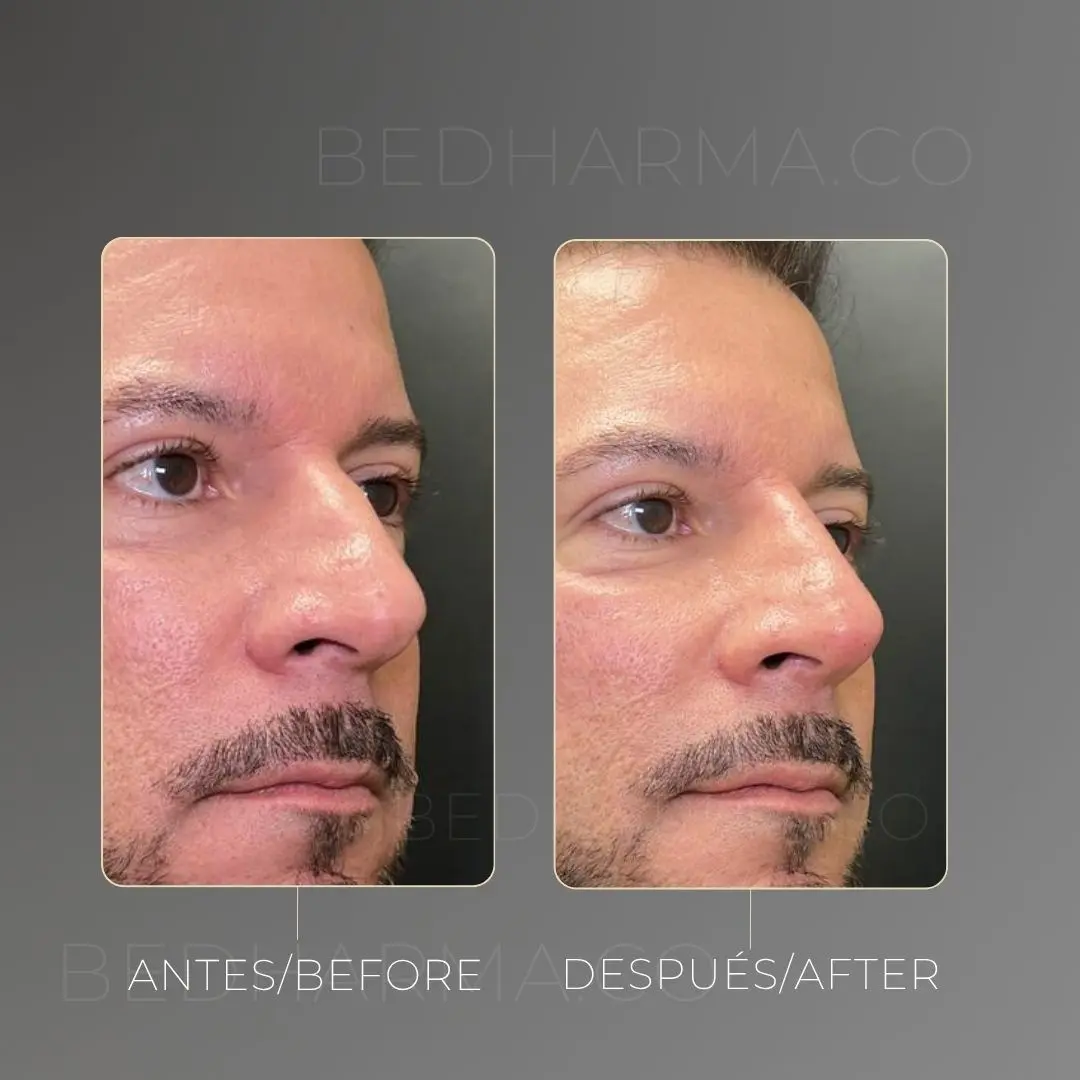 Non-surgical nose job before and after at Be Dharma in Medellín — case 2
