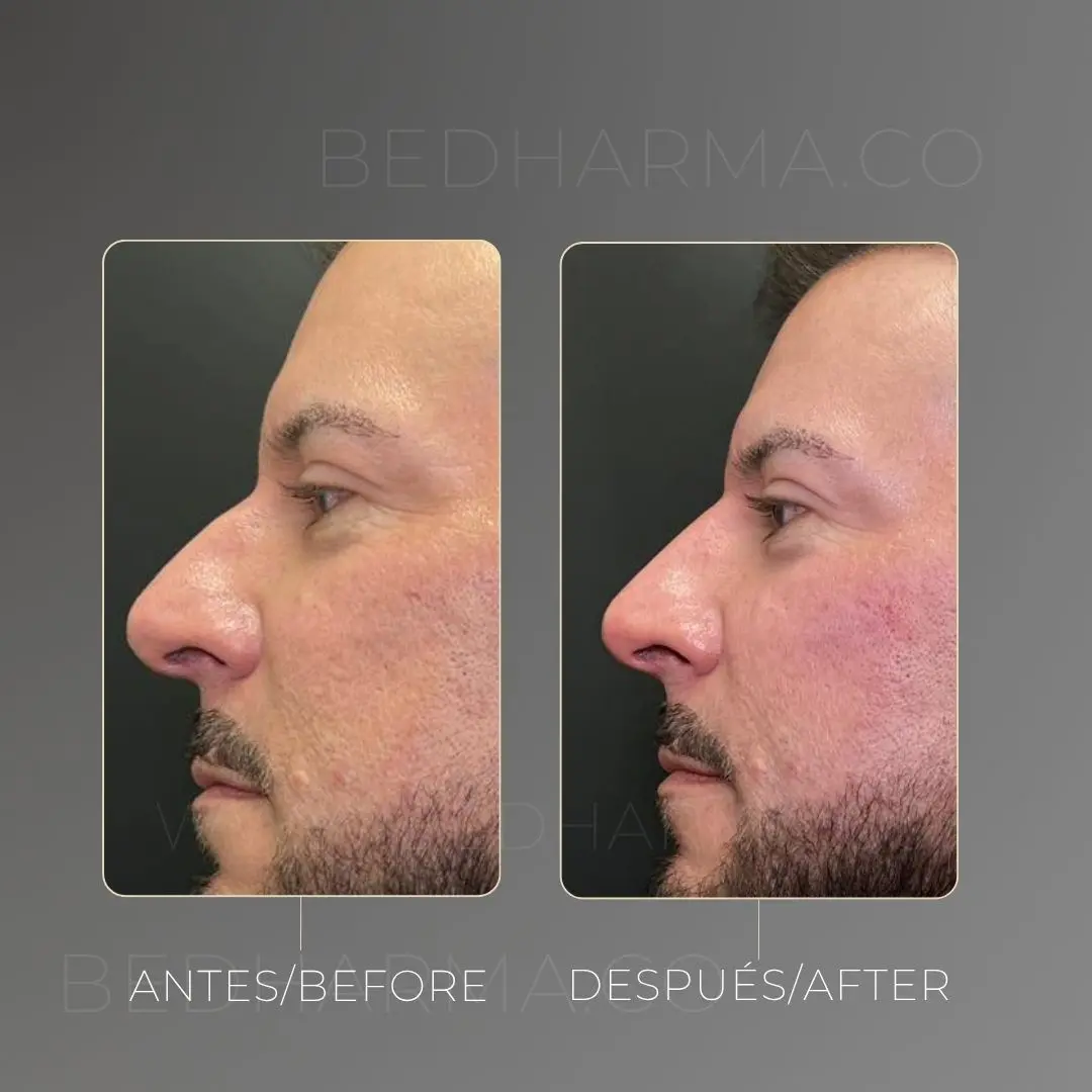 Non-surgical nose job before and after at Be Dharma in Medellín — case 3